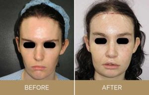 Facial feminization surgery USA